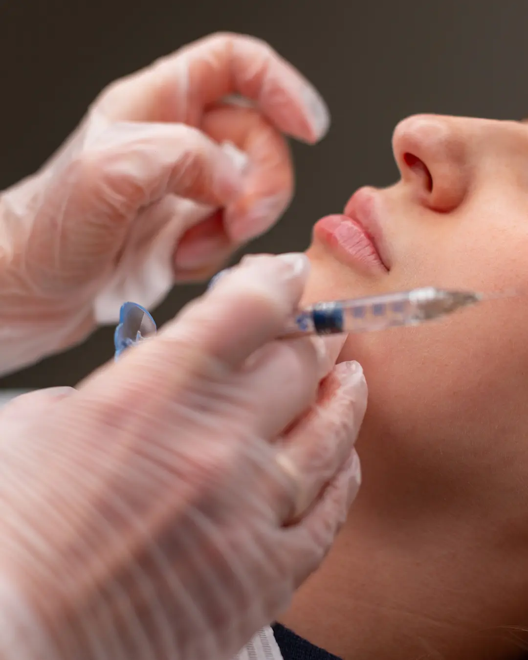 Balancing facial volume with dermal fillers