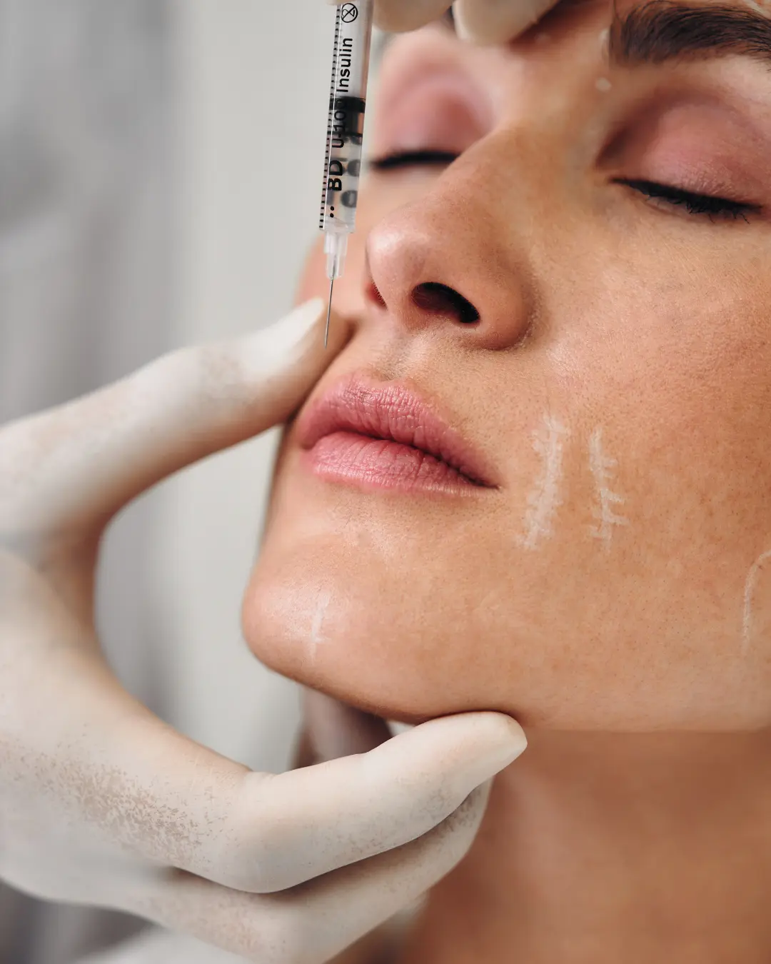 Cheek contouring dermal filler treatment